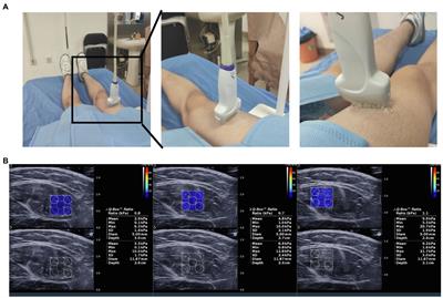Ultrasonic Elastography of the Rectus Femoris, a Potential Tool to Predict Sarcopenia in Patients With Chronic Obstructive Pulmonary Disease